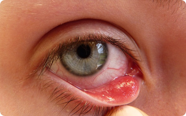 How to get rid of a Stye