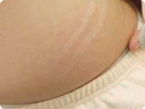 How to get rid of stretch marks