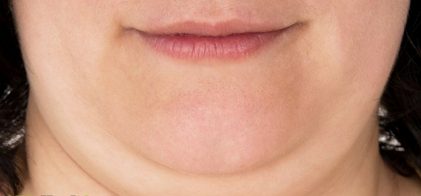 How to get rid of double chin