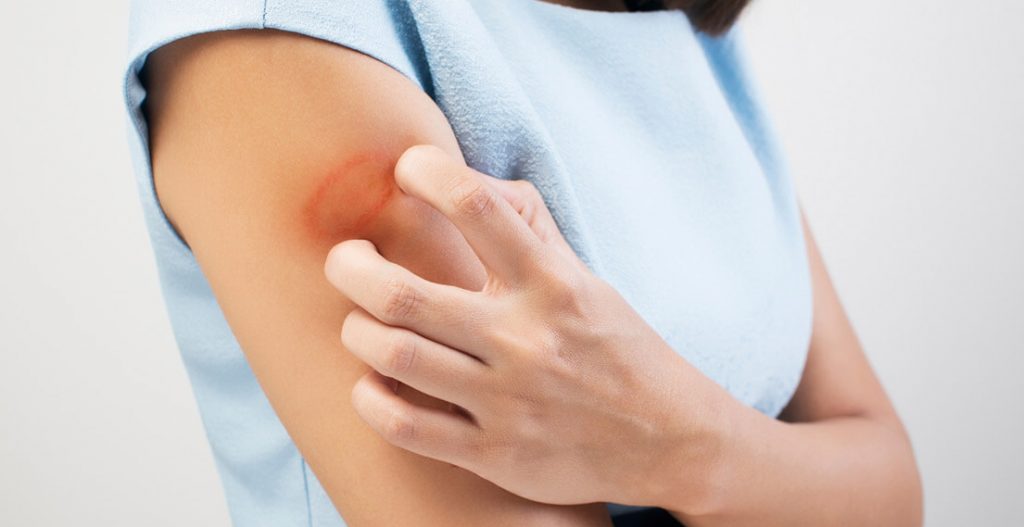 How to get rid of ringworm