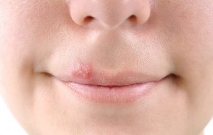 How to get rid of a cold sore