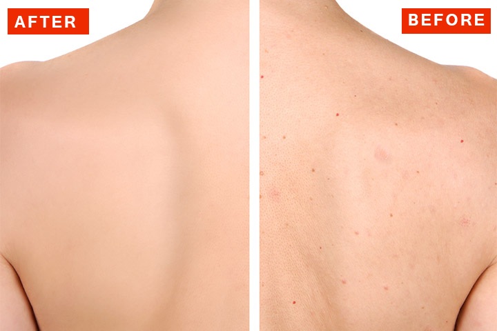 How to get rid of back acne