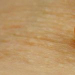 How to get rid of skin tags