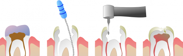 Root Canal