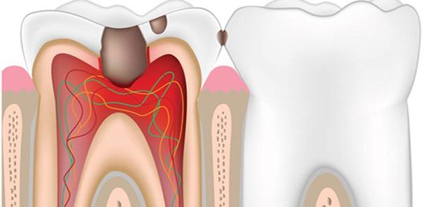 Root Canal